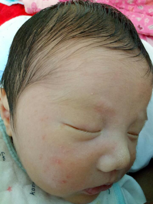 婴儿面颊部痱子图片