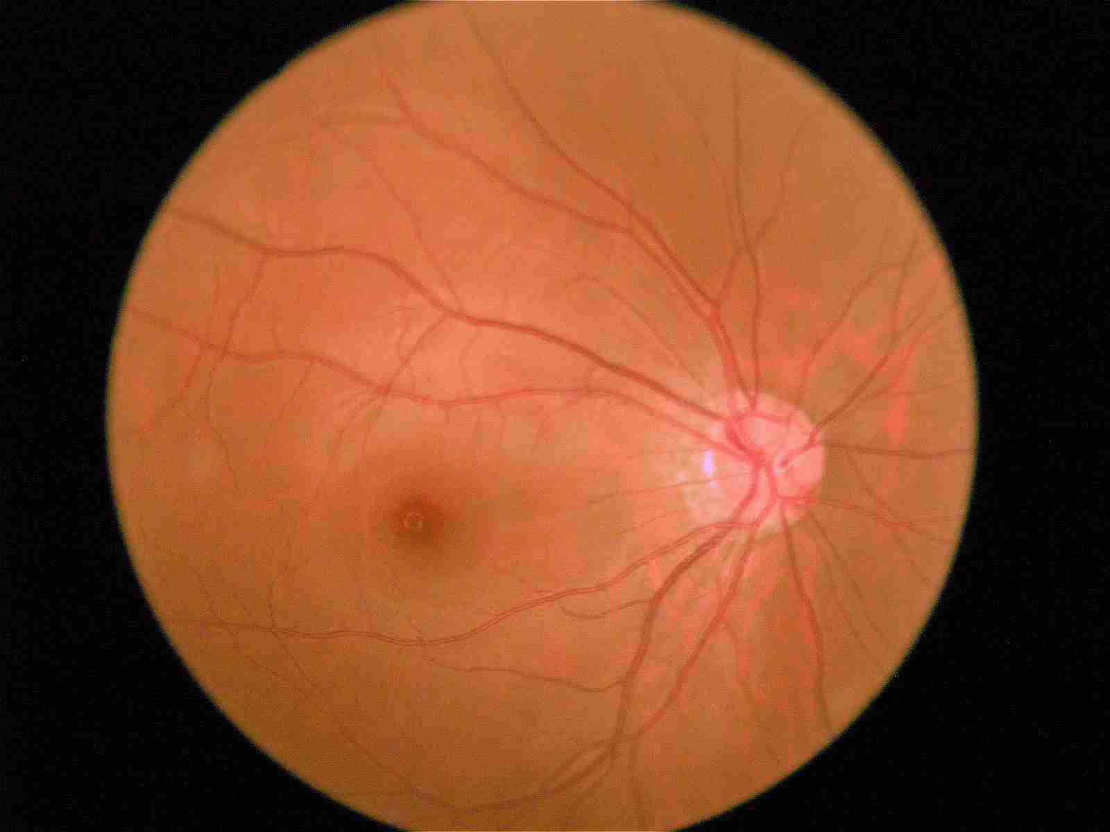 9个问题让你彻底读懂：糖尿病眼底病变做激光治疗是怎么回事_视网膜