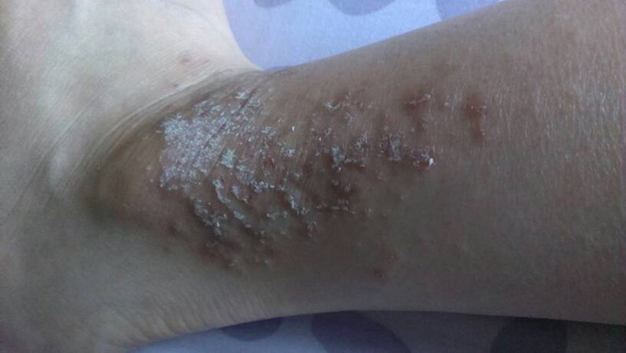 真菌性皮肤病腿部图片