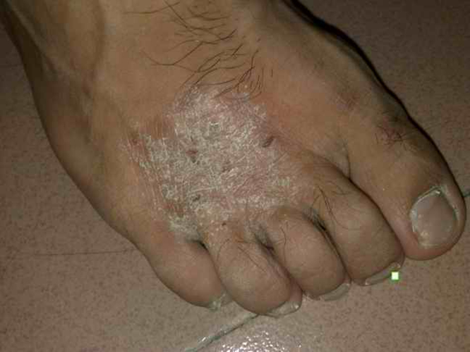 真菌性皮肤病脚背
