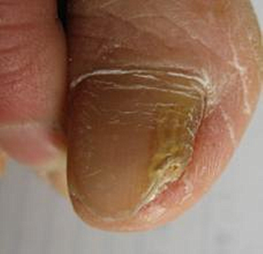 真菌性皮肤病脚部脚趾甲