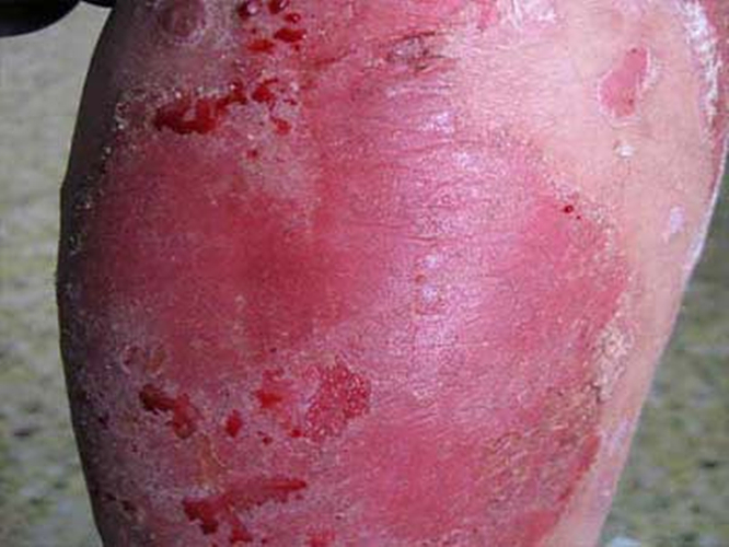 真菌性皮肤病腿