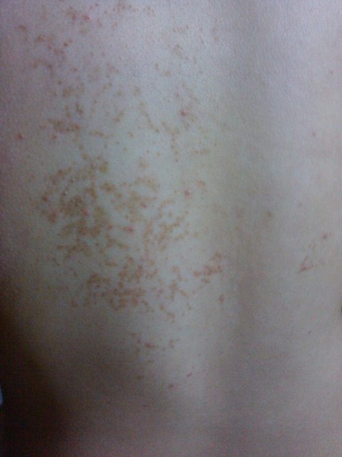 真菌性皮肤病背部的图片