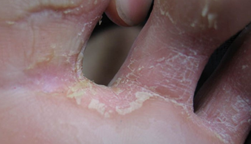 真菌性皮肤病脚