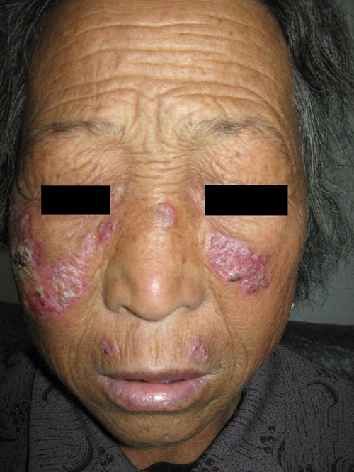 老奶奶患系统性红斑狼疮图片