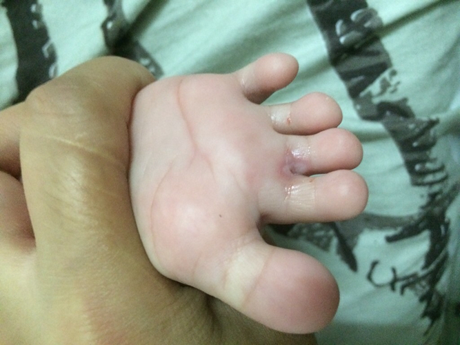 婴儿脚气症状图片