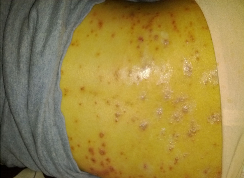 肛周湿疹早期症状图片图片