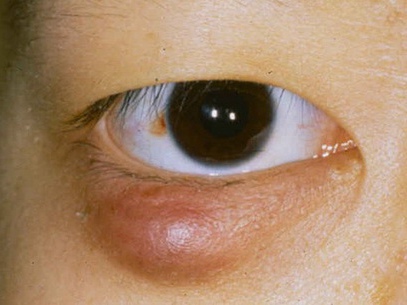 眼睑乳头状瘤图片