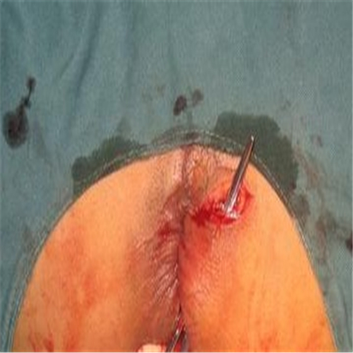 女性肛周脓肿手术图片