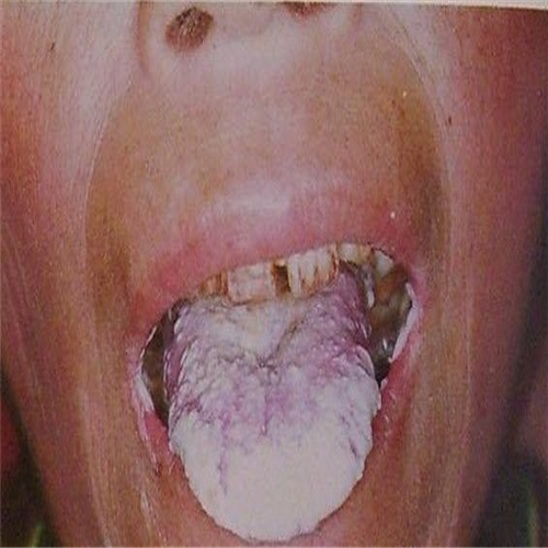 艾滋病口腔粘膜图片图片