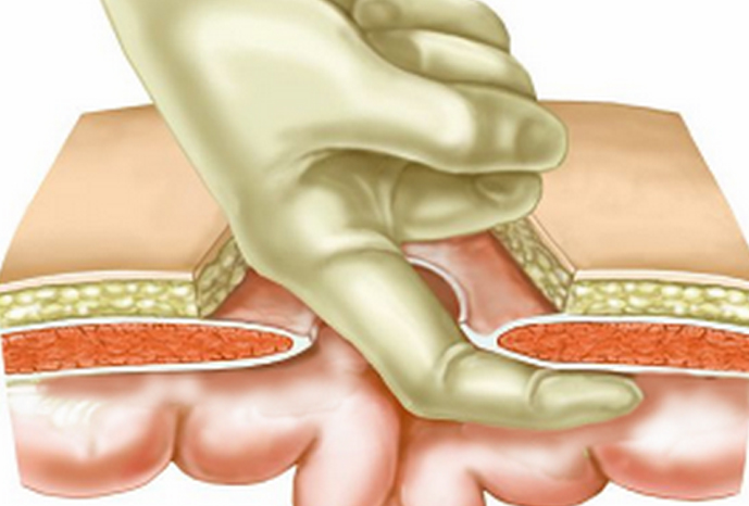 小儿疝气手术方法图