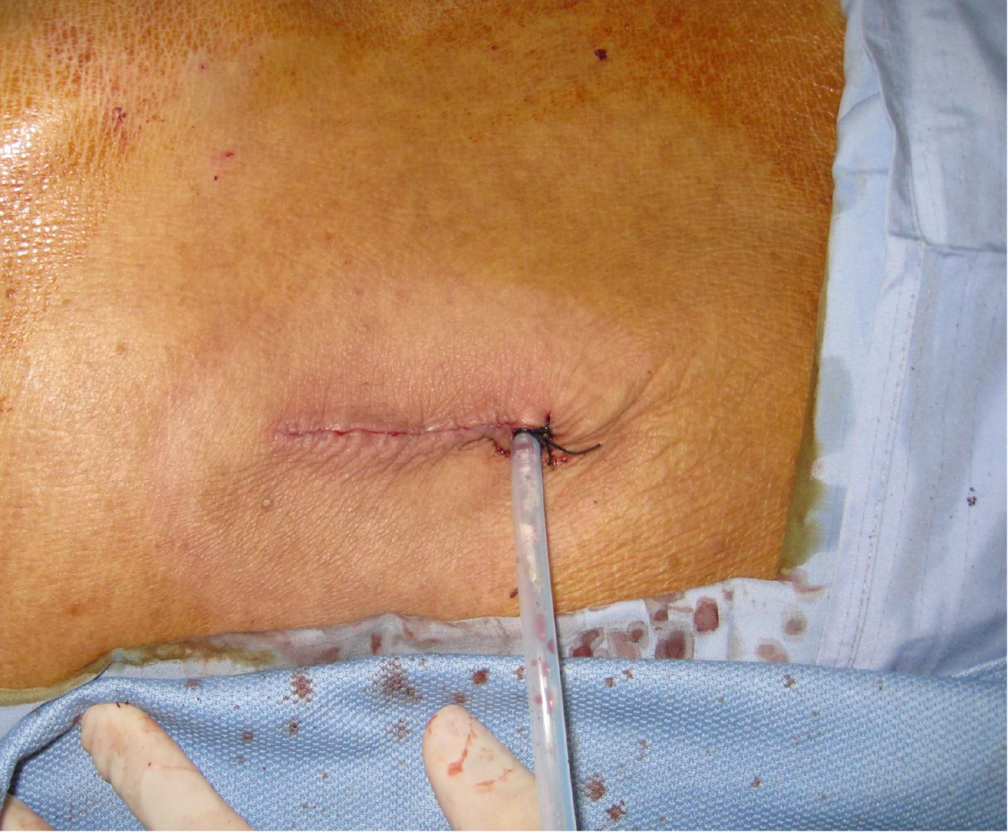 阑尾炎手术切口图片
