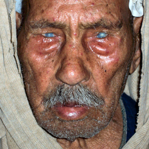人的沙眼严重症状的图片