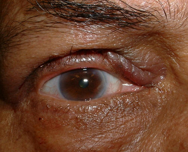 手术后右眼沙眼的图片