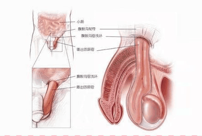 小儿疝气示意图片