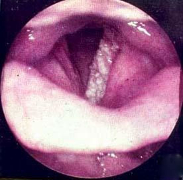 严重喉血管瘤图片
