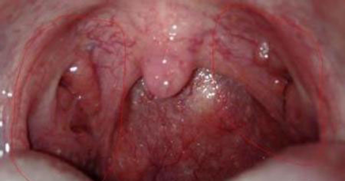 喉血管瘤严重红肿的图片