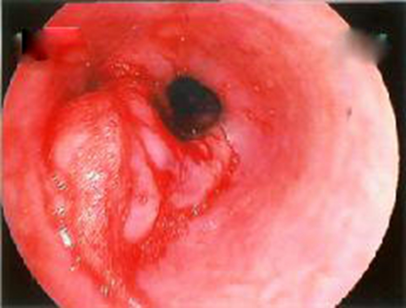 典型喉血管瘤图片