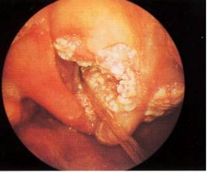喉血管瘤晚期图片