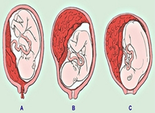 胎盘早剥分类图片