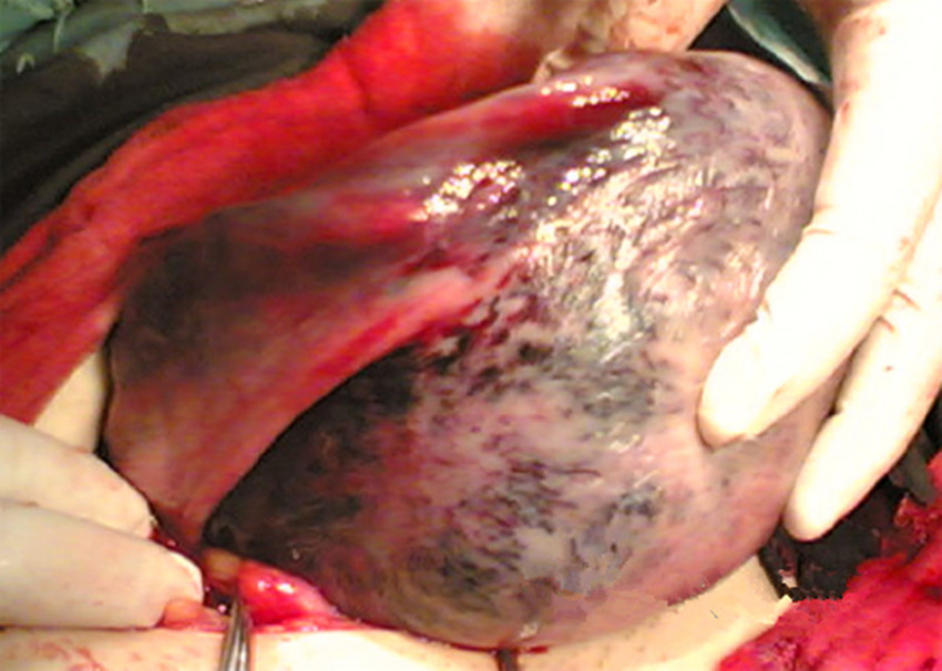 胎盘早剥手术图片