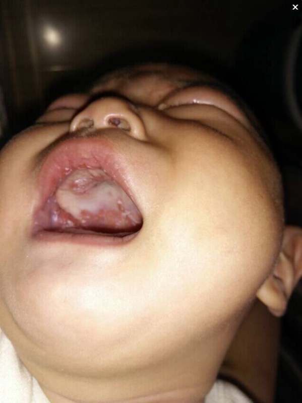 4个月婴儿鹅口疮图片图片