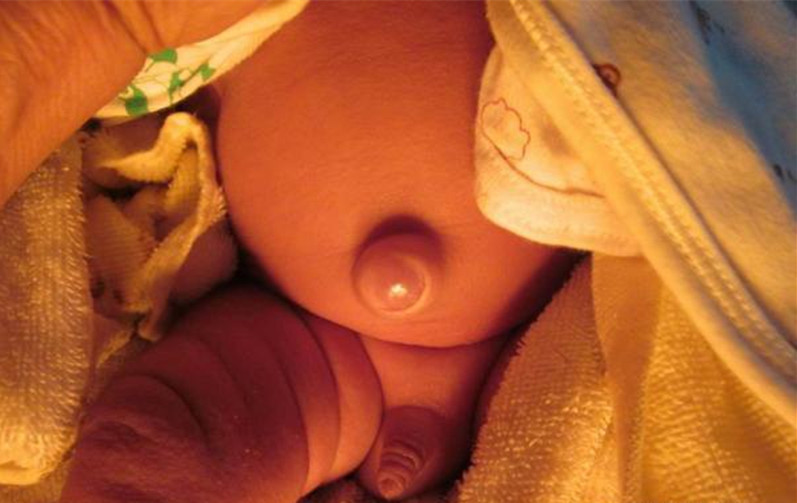 婴儿肚脐上的白线疝图片