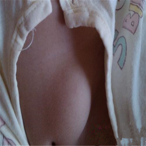 宝宝白线疝症状’图片