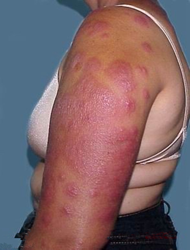 药物性皮炎胳膊上大面积红斑图片