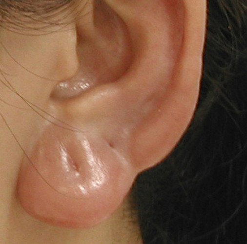 耳廓皮脂腺囊肿图片