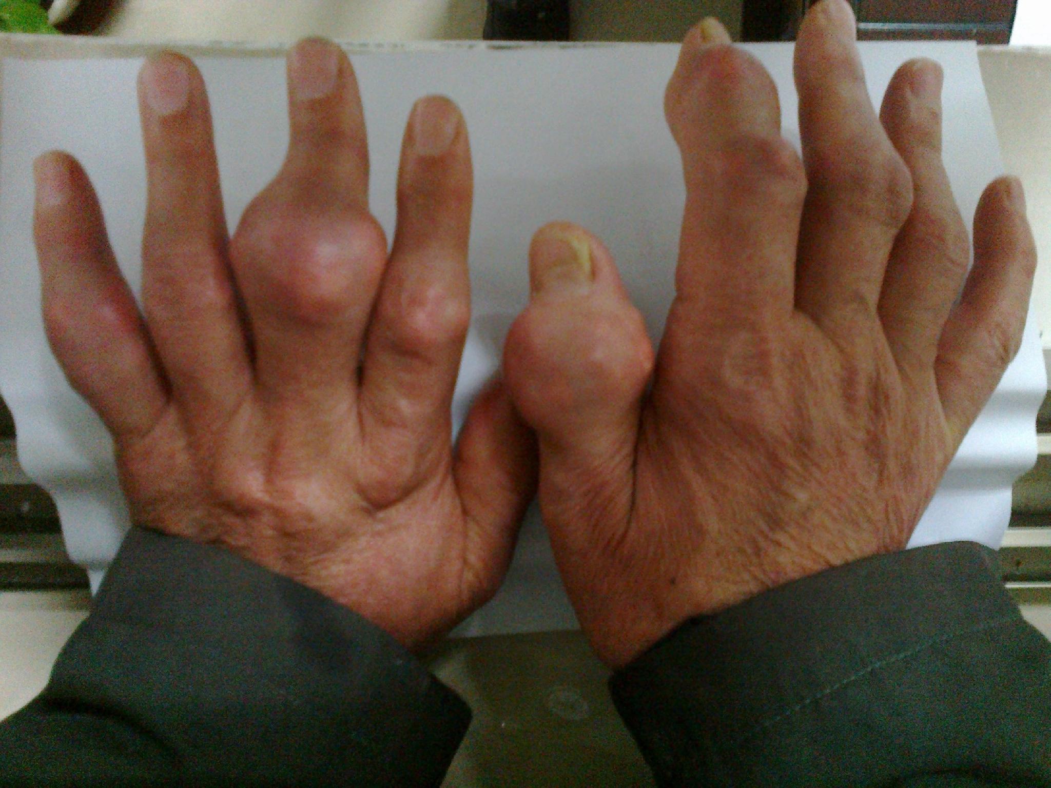 手指关节痛风石图片图片