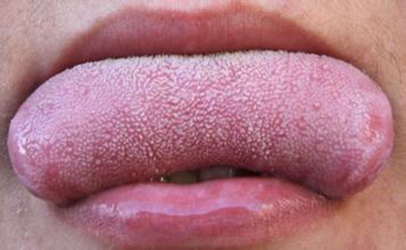 艾滋病女性初期舌头有什么症状图片