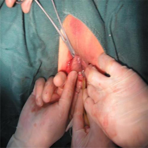 幼儿肛周脓肿引流手术图片