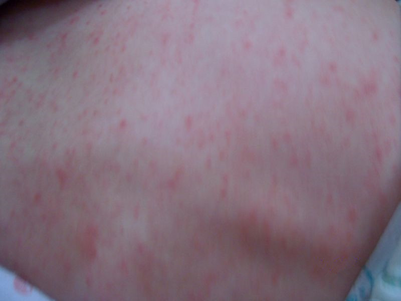 这是麻疹症状吗的图片