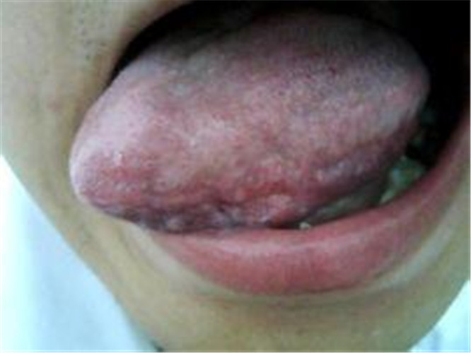 儿童嘴唇内侧单纯性疱疹严重症状图片