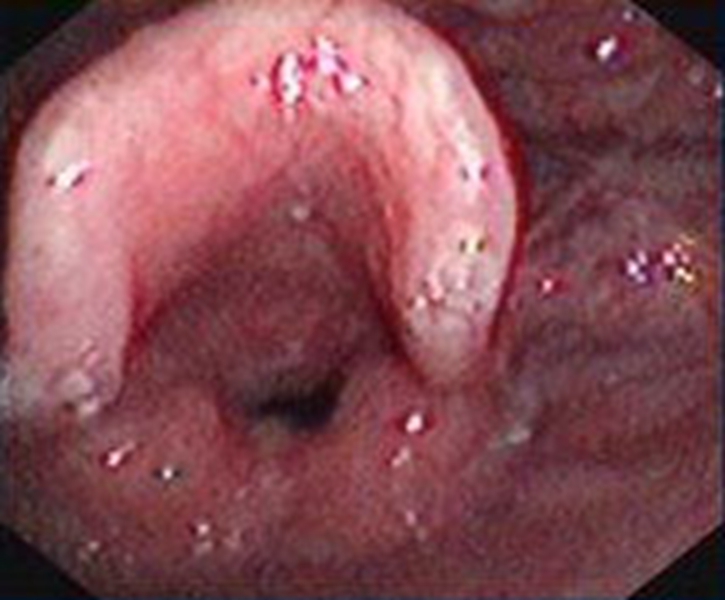 喉血管瘤中期图片