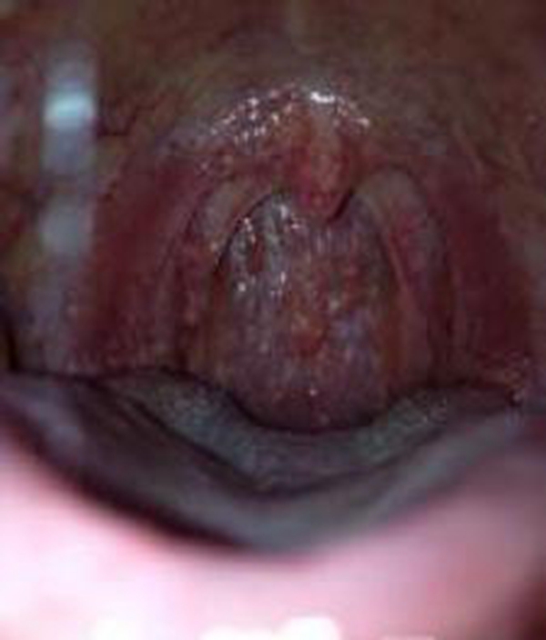 初期喉血管瘤图片