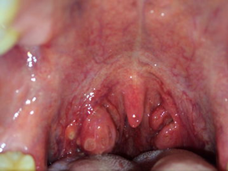 喉血管瘤晚期的图片
