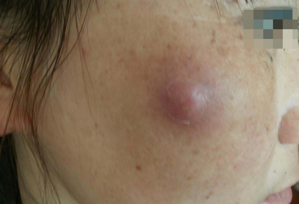 皮脂腺囊肿后期图片图片