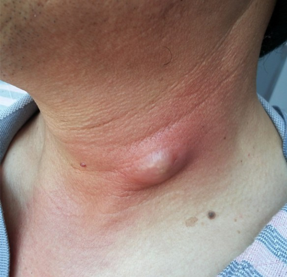脖子的皮脂腺囊肿的图片