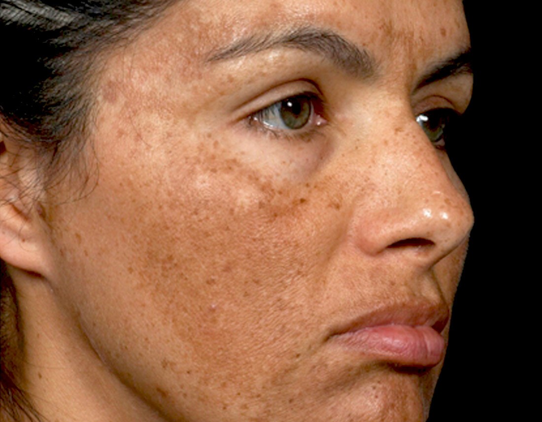 面部色斑的分类及治疗 - 知乎