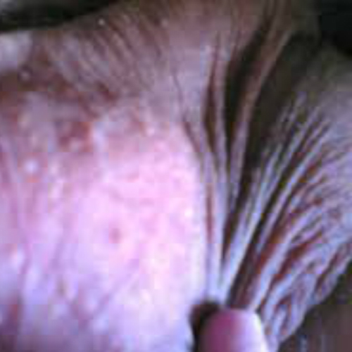 男人外阴湿疹的症状及图片