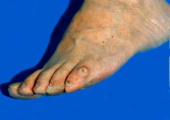 人的脚放射性皮炎图片