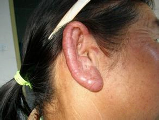 耳朵皮肤结核病图片