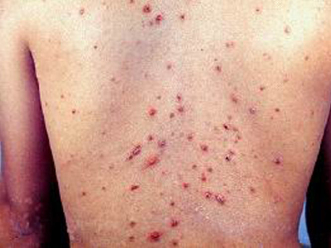 人体的背部皮肤结核病图片