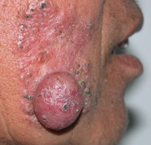 右侧面部的皮肤结核病图片