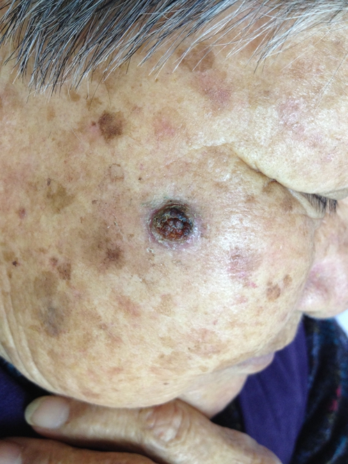 皮肤良性肿瘤早期图片图片