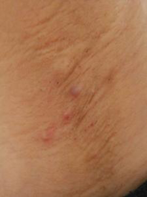 腋窝皮脂腺瘤图片