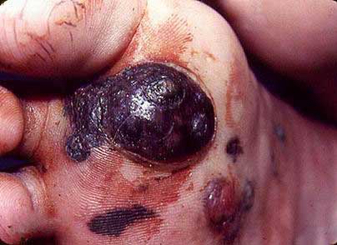 足底恶性黑色素瘤皮肤肿瘤图片