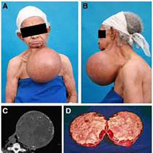 男性甲状腺瘤的症状表现图片